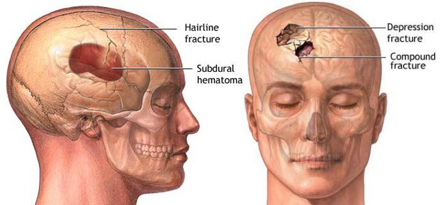 Differenti tipologie di fratture del cranio